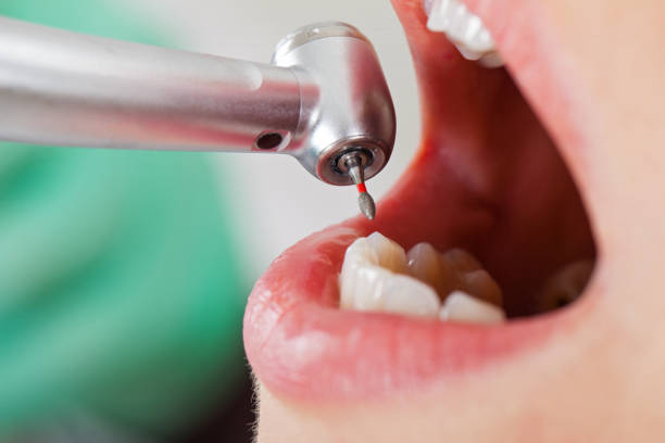 Best Emergency Tooth Extraction in Beesleys Point, NJ